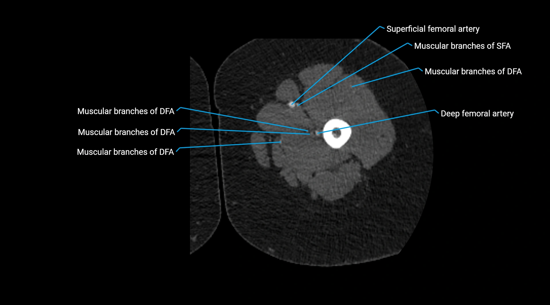 CTA lower limb cross sectional anatomy labelled image _106.webp